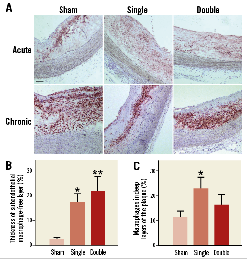 Cryotherapy increases features of plaque stability in 