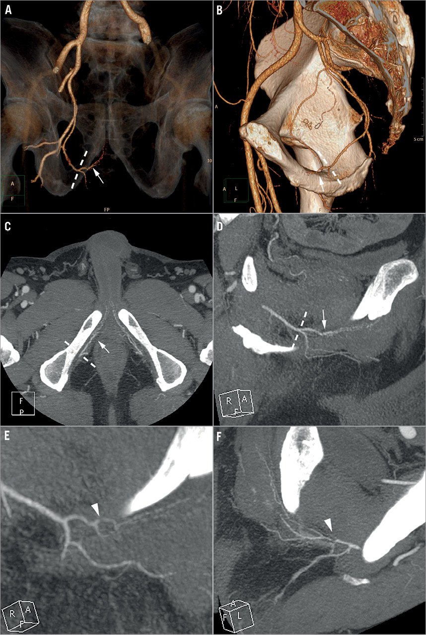 Safety and six month durability of angioplasty for isolated penile