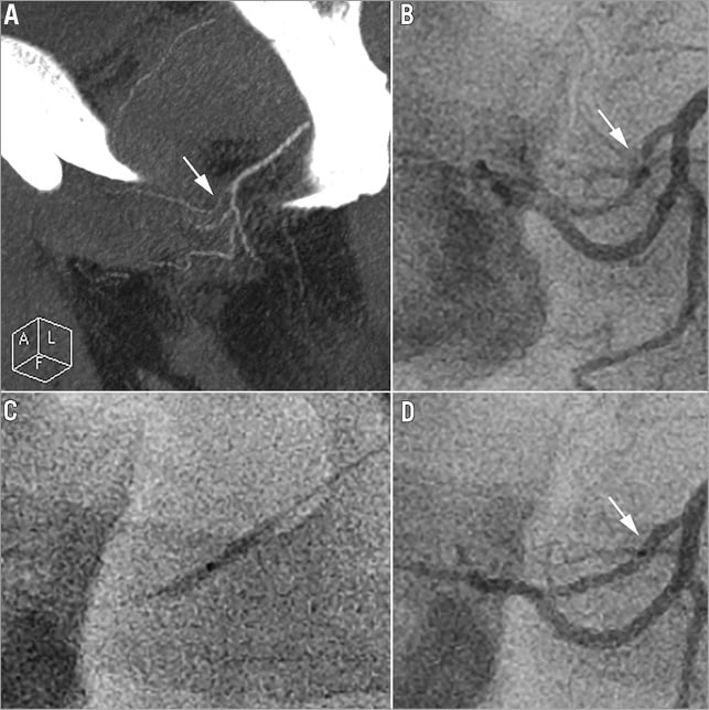 Safety and six month durability of angioplasty for isolated penile