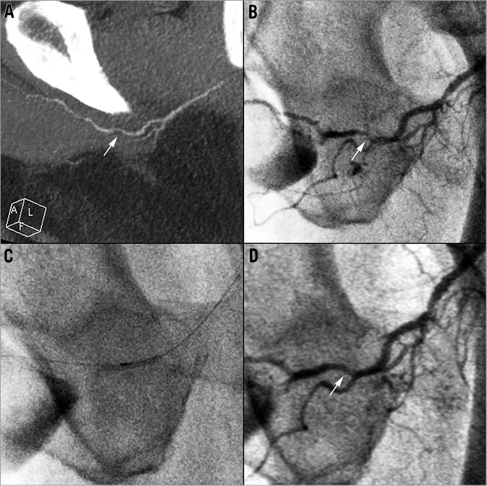 Safety and six month durability of angioplasty for isolated penile