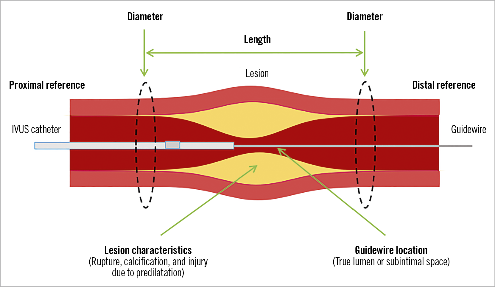 Figure 1. Role of pre-stenting IVUS. IVUS information on reference vessel/lumen diameter, lesion length, lesion characteristics and guidewire location can help with optimal stent implantation.