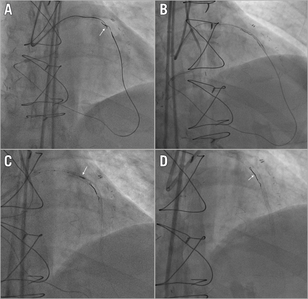 Figure 2. Guidewire entrapment: clean controlled tip rupture. A) A retrograde Gaia Second (Asahi Intecc, Aichi, Japan) knuckled wire knot (white arrow). B) Controlled rupture by simultaneous microcatheter pushing and guidewire pulling. C) IVUS evaluation (white arrow) for guidewire unravelling. D) Complete stent coverage of the unravelled guidewire fragment (white arrow).