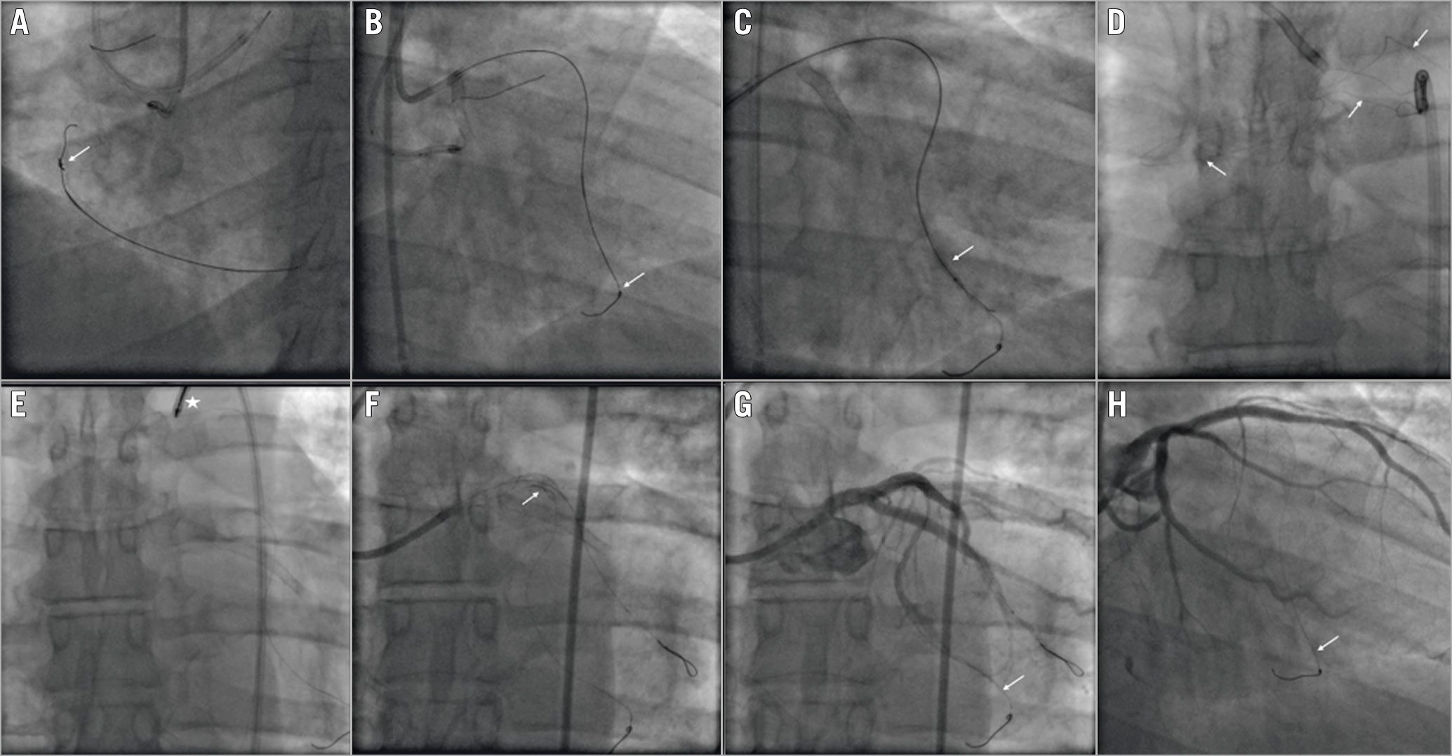 Figure 3. Guidewire entrapment: unfolding of the coil into small filaments. A) A retrograde ULTIMATEbros 3 (Asahi Intecc) guidewire knot (white arrow). B) Guidewire entrapment into the septal branch (white arrow). C) Balloon angioplasty around the entrapped guidewire (white arrow). D) Guidewire unfolding into a small filament (white arrows). E) Snaring of the unravelled guidewire fragment (white asterisk). F) Left main and proximal LAD stenting to trap the unravelled fragment (white arrow). G) Final result (white arrow showing the entrapped guidewire). H) Six-month coronary angiography follow-up (white arrow showing the entrapped guidewire).