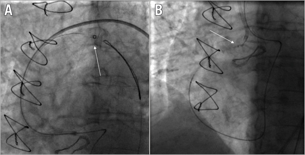 Figure 4. Guidewire entrapment requiring surgical removal. A) Snaring of an RG3 guidewire (Asahi Intecc) during a retrograde PCI of an ostial RCA CTO (white arrow). B) RG3 wire entanglement (white arrow) within the biological aortic prosthesis valve mesh.