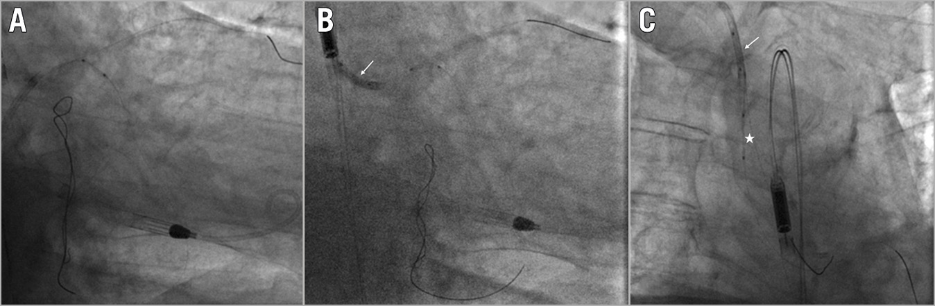 Figure 6. Balloon entrapment. A) Balloon-catheter shaft rupture. B) Trapping of the retained fragment with a balloon into the guide catheter (white arrow). C) Successful retrieval of the entrapped balloon (white asterisk) as a unit (white arrow indicating the trapping balloon).