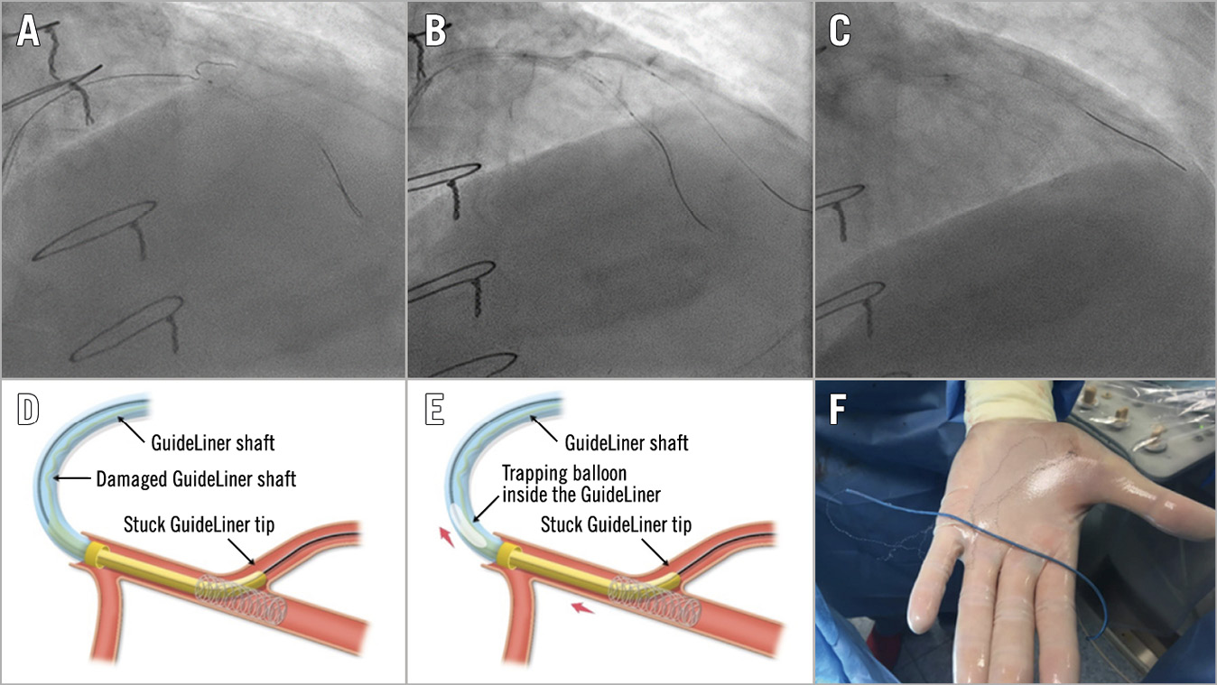 Figure 7. Guide catheter extension entrapment. A) Wiring of the diagonal branch. B) Balloon dilatation of the stent struts across the diagonal branch. C) Entrapment of the guiding catheter extension within the stent struts. D) Torn and damaged shaft of the guiding extension. E) Successful retrieval by inflating a balloon into the distal cylinder of the extension device followed by pulling the whole system out as a unit. F) Complete retrieval of the entrapped device.
