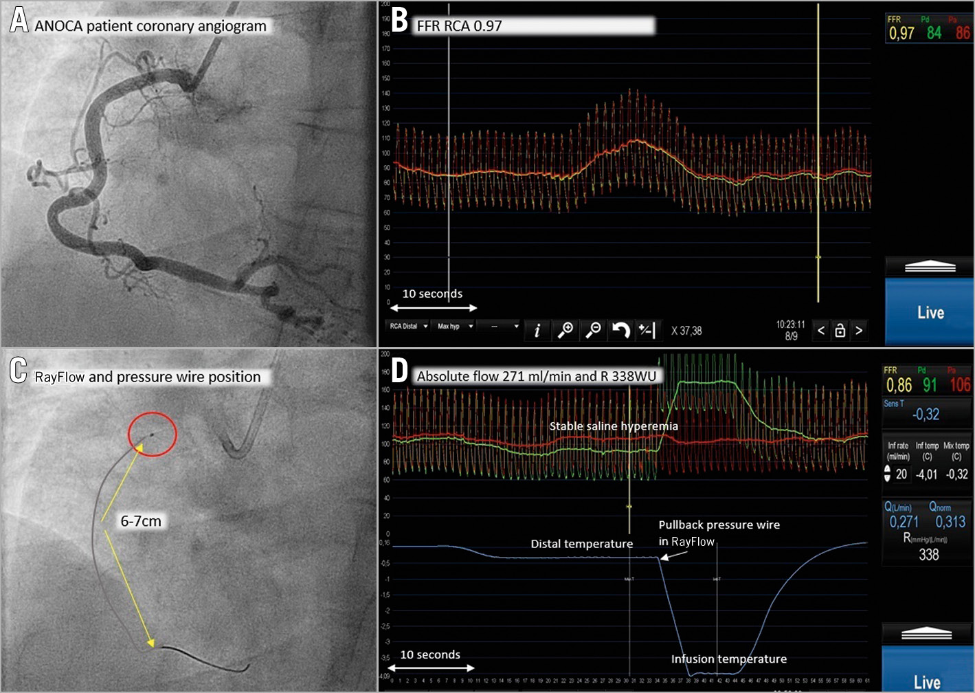 Figure 1. Procedural example. Normal RCA with FFR and absolute flow/resistance measurements. Extensive legend in Supplementary Appendix 1.