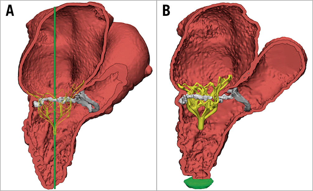 Figure 1. CT analysis of the predicted (A) valve implantation compared to the actual (B) result in a patient with a Trifecta bioprosthetic surgical valve and severe mitral annular calcification (MAC).