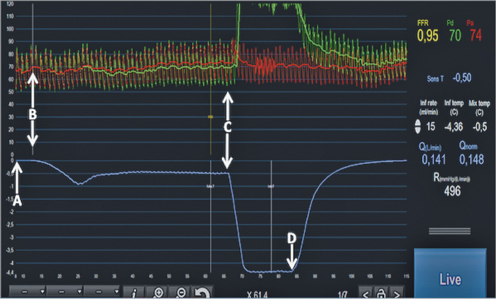Figure 1. Example of simultaneous pressures (upper tracings, Pa in red, Pd in green) and temperature recording (lower tracing, in blue) in a coronary artery. First, the temperature is “zeroed” (arrow A). This means that the body temperature prior to the measurement is considered as the zero. Soon after the start of the infusion of saline at room temperature (arrow B), the temperature measured in the distal artery (T) decreases and stabilises at −0.50°C below the zero line and the Pd starts to decrease slightly, indicating the presence of a higher coronary flow. Then, the sensor is pulled back (arrow C) and placed just in front of the inner holes of the RayFlow catheter (i.e., 2.5 mm distal to the marker on the RayFlow). This translates into a sharp decline of the temperature that stabilises at −4.36°C. This value corresponds to the difference between body temperature and the saline at the location where saline enters the coronary artery (Ti). Simultaneously, an increase in Pd is noted exceeding Pa. This is related to the fact that the pressure sensor is now located in the lumen of the infusion catheter and is influenced by the pressure delivered by the infusion pump. Finally, the infusion is stopped (arrow D), allowing both the pressure and the temperature to return to baseline. All relevant physiologic parameters (FFR, Pd, Pa, infusion rate of saline, distal coronary temperature [T], infusion temperature [Ti], actual flow [Q], normalised flow [Qnorm] and minimal microvascular resistance [Rmicro]) are displayed instantaneously on the screen of any monitor by the CoroFlow software.