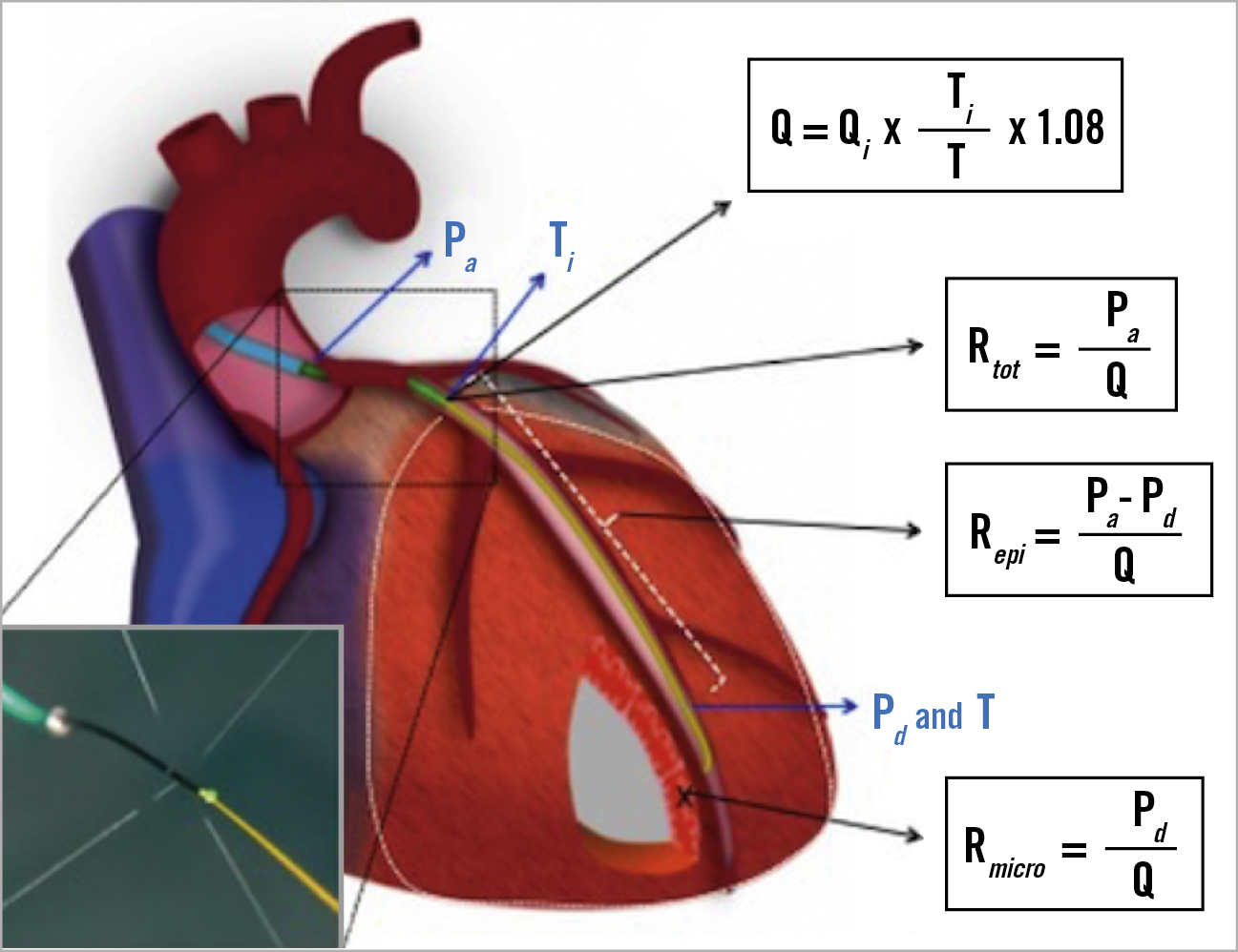 Figure 2. Comprehensive physiological framework of the entire coronary circulation. In the lower left corner, the infusion of saline through the dedicated catheter is shown.