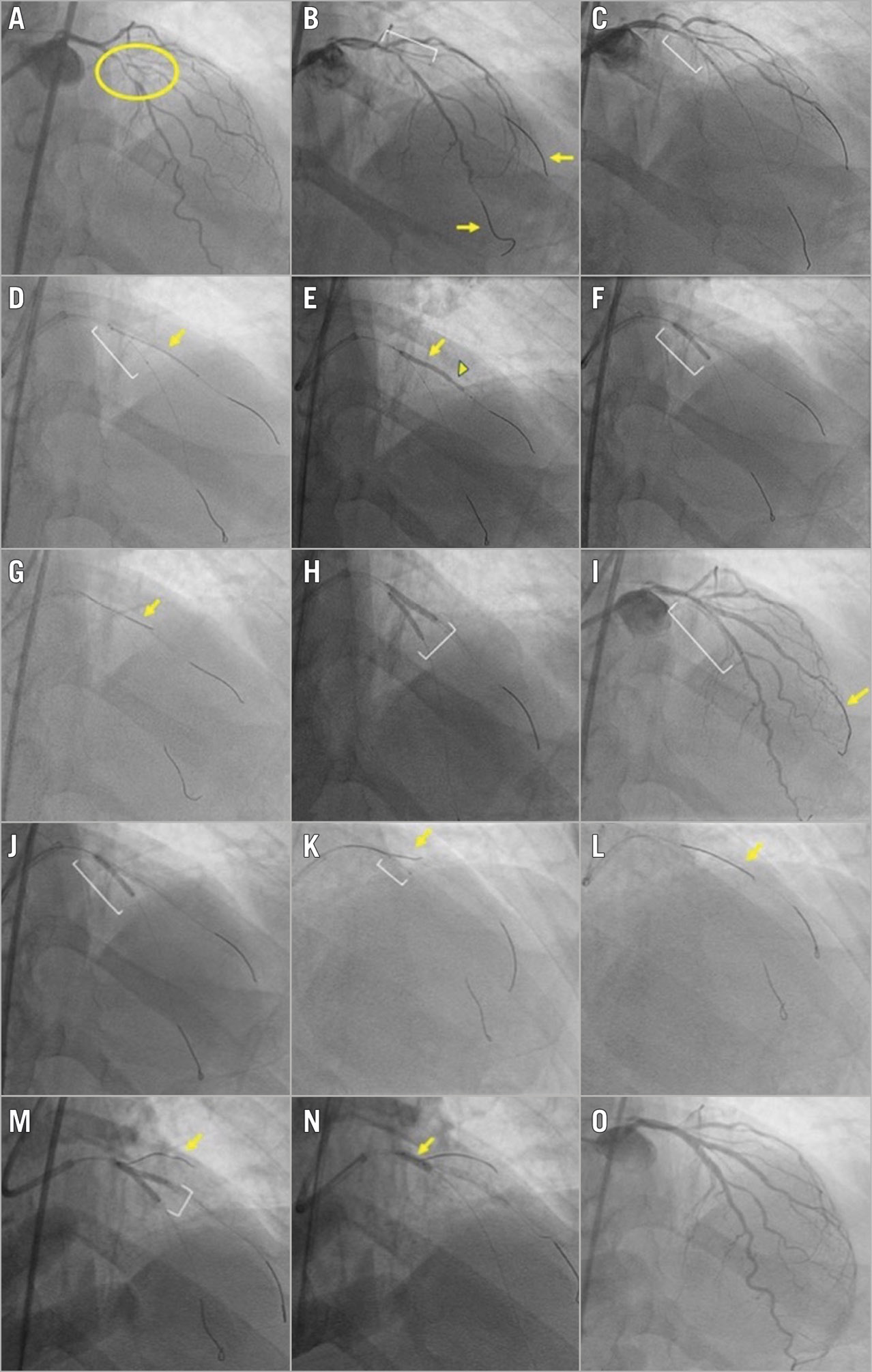 Figure 1. Angiographic case example of a bifurcation lesion treated successfully with the double kissing crush technique. A) Medina 1,1,1 bifurcation lesion (yellow circle) with significant disease involving the mid left anterior descending (LAD) artery and the bifurcating second diagonal branch. The bifurcation angle is <70°. The side branch supplies a large myocardial segment. B) Wires (yellow arrows) are placed in both the LAD (main vessel) and the diagonal branch (side branch). A balloon (white bracket) is placed in the diagonal branch for predilation. C) A balloon (white bracket) is placed in the LAD for predilation. D) A stent (yellow arrow) is positioned in the diagonal branch. A balloon (white bracket) is pre-positioned in the LAD prior to deploying the diagonal stent to allow subsequent crushing of the diagonal branch stent. E) The diagonal branch stent is deployed (yellow arrow). The angiographic result in the diagonal is optimised (for example to correct stent underexpansion indicated by arrowhead) prior to crushing the side branch stent. F) The LAD balloon (white bracket) is inflated, crushing the diagonal stent. G) A new wire (yellow arrow) is used to re-wire the crushed diagonal branch stent and the original diagonal wire is removed. H) The first simultaneous kissing balloon inflation (white bracket) is performed in the LAD and diagonal branch. I) The LAD stent is positioned (white bracket); the diagonal wire (yellow arrow) is not removed. J) The LAD stent (white bracket) is deployed, followed by proximal optimisation technique (POT) of the main vessel stent (not imaged). K) Due to difficulty re-wiring the diagonal branch, a Twin-Pass® Torque (Teleflex) dual-lumen microcatheter (white bracket) is used, with successful advancement of a new wire (yellow arrow) through the over-the-wire port of the device. L) The jailed diagonal wire (yellow arrow) is removed. M) The second simultaneous kissing balloon inflation (white bracket) is performed. A wire (yellow arrow) was placed in a more proximal first diagonal to maintain access to the vessel. N) Repeat POT is performed, with balloon inflation (yellow arrow) within the proximal main branch (LAD) stent up to the carina. O) Excellent final angiographic result.