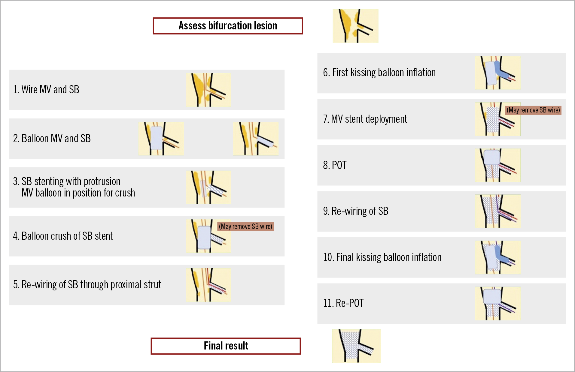 Figure 2. The steps of the double kissing crush bifurcation stenting technique. The numbers to the left of each image correspond to the step number and affiliated troubleshooting information provided for each step within the body of the text.