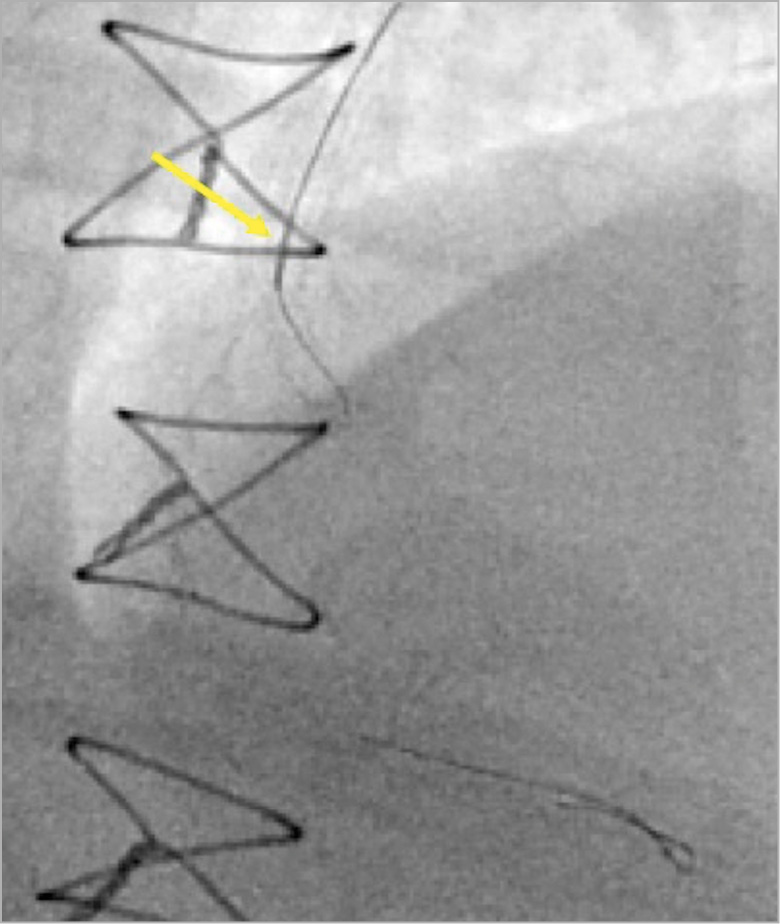 Figure 6. A microcatheter (yellow arrow) is used to direct a wire into an obtuse marginal branch.
