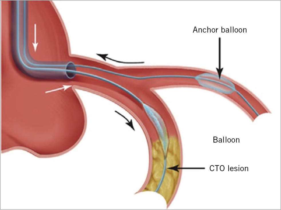 Figure 8. Use of an anchor balloon in a side branch to increase support for advancement of equipment in the main branch in chronic total occlusion (CTO) percutaneous coronary intervention (PCI). This technique can be adapted for use when equipment is difficult to advance into the main branch or even side branch, when performing double kissing crush bifurcation stenting.