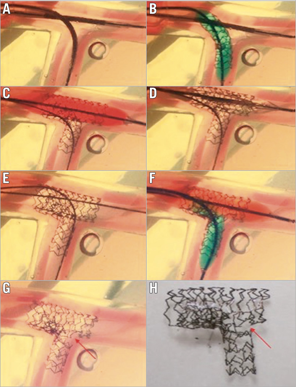 Figure 10. Drawback of too distal SB re-crossing in the classic crush technique. A) Position of MV and SB stents. B) SB stent deployment. C) MV stent deployment to crush the SB stent. D) Gap formation near the carina. E) Distal SB re-crossing, wire going between the SB stent and vessel wall. F) Final kissing balloon inflation. G) & H) Leaving a significant gap near the carina. MV: main vessel; SB: side branch Reprinted from Zhang JJ and Chen SL. Classic crush and DK crush stenting techniques. EuroIntervention. 2015;11:V102-V105. With permission from Europa Digital & Publishing.