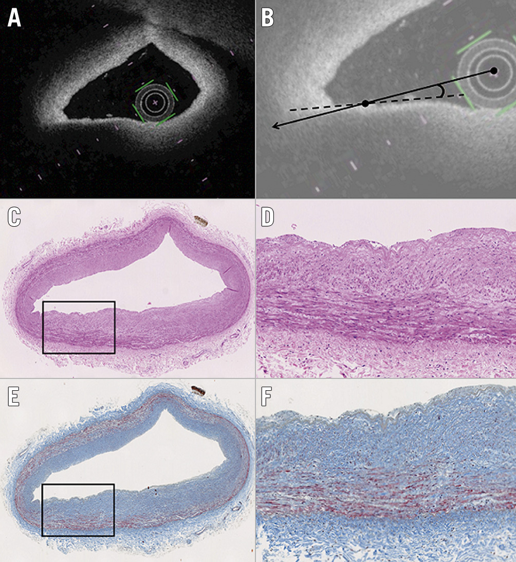 Figure 4. Representative images of TSD artefact. Although a signal-poor lesion with a diffuse border appears to be located at 7-8 o’clock on the OFDI image (A), the histological segment (haematoxylin and eosin, and Masson’s trichrome staining) (C & E) shows adaptive intimal thickening. B) The angle θ between the OFDI beam that strikes the edge of the luminal surface of the low-intensity region (continuous line) and that which strikes the surface line of the low-intensity region (dotted line) was 4°. D) & F) Magnified images of the boxed areas in panels C and E. OFDI: optical frequency domain imaging; TSD: tangential signal dropout