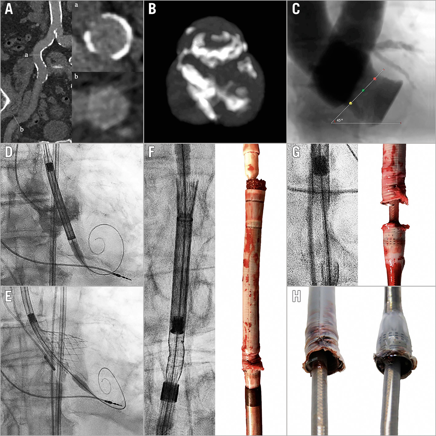 Figure 1. Delivery catheter system fracture during TAVI. A) Moderately calcified and tortuous iliofemoral arteries. B) & C) Moderately calcified and angulated trileaflet aortic valve. D) & E) Positioning, deployment and recapture of a 34 mm Evolut R valve. F) – H) Fractured delivery catheter system. Reproduced with permission from Medtronic.