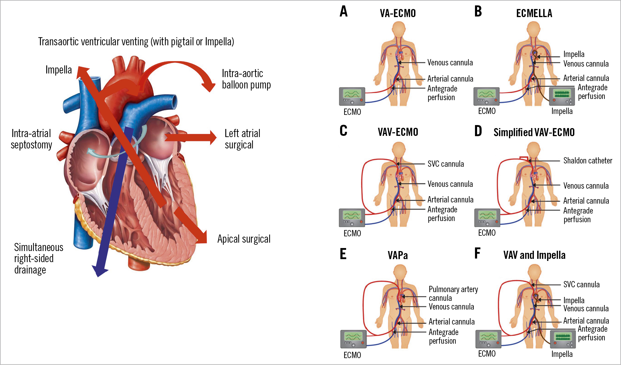 Figure 4. Left: considerations on potential surgical or percutaneous approaches to unload the left ventricle in the setting of venoarterial extracorporeal membrane oxygenation. Right: venoarterial extracorporeal membrane oxygenation and upgrades in cardiogenic shock and lung failure.