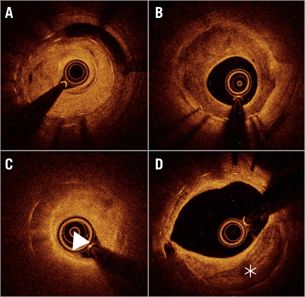 Figure 1. Representative optical coherence tomography image. A) Homogenous neointima. B) Heterogenous neointima. C) Lipid neointima (arrow). D) Calcified neointima (asterisk).