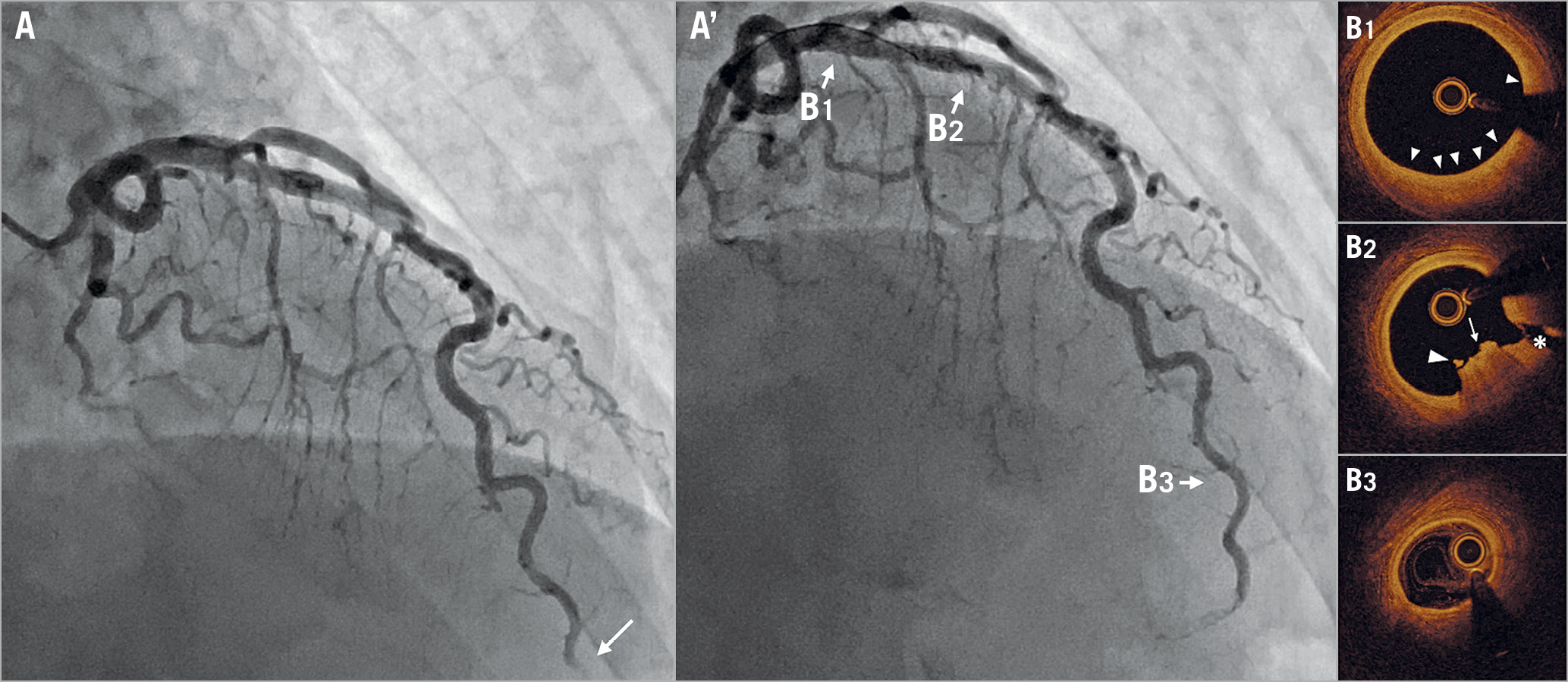 Figure 1. Coronary angiography and OCT images after thrombus aspiration from the distal portion of the LAD. Initial coronary angiography (A, Moving image 1) showed total occlusion at the distal portion of the LAD (arrow). Coronary flow was recovered after thrombus aspiration (A’). OCT pullback was from distal to proximal of the LAD. OCT pullback was performed twice to investigate the long lesions of the LAD. The first pullback was from the distal to the middle portion and the second pullback was from the middle portion to the guiding catheter (Moving image 2, Moving image 3). At the proximal segment, there was intimal hyperplasia (B1), and plaque erosion with thrombus (arrows), and the side branch (asterisk) were observed (B2). At the distal portion, three layers of coronary artery wall were maintained (B3).