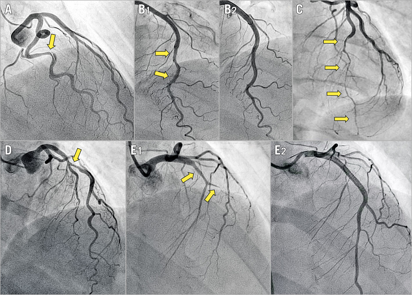 Figure 1. Angiographic classification of SCAD. Arrows indicate the dissected segments. A) Angiotype 1, radiolucent flap or dual lumen. B1) Angiotype 2A, long (>20 mm) narrowing with distal calibre recovery. B2) Vessel restoration three months after conservative management of B1. C) Angiotype 2B, long (>20 mm) narrowing involving the main distal vessel. D) Angiotype 3, focal (<20 mm), sometimes tubular stenosis. E1) Angiotype 4, total occlusion of the main vessel. E2) Flow restoration after stenting.