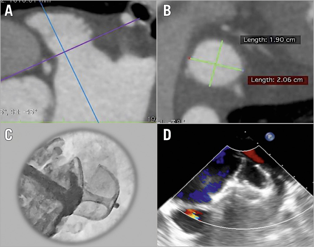 Figure 2. Procedural planning and implantation of the Omega left atrial appendage (LAA) occluder. A) Cardiac CT identification and assessment of LAA anatomy. B) Measurement of the LAA landing zone. C) In vivo deployment of the Omega device showing occlusion of the LAA with contrast injection. D) Procedural transoesophageal echocardiography showing the deployed Omega device and no residual flow into the LAA.