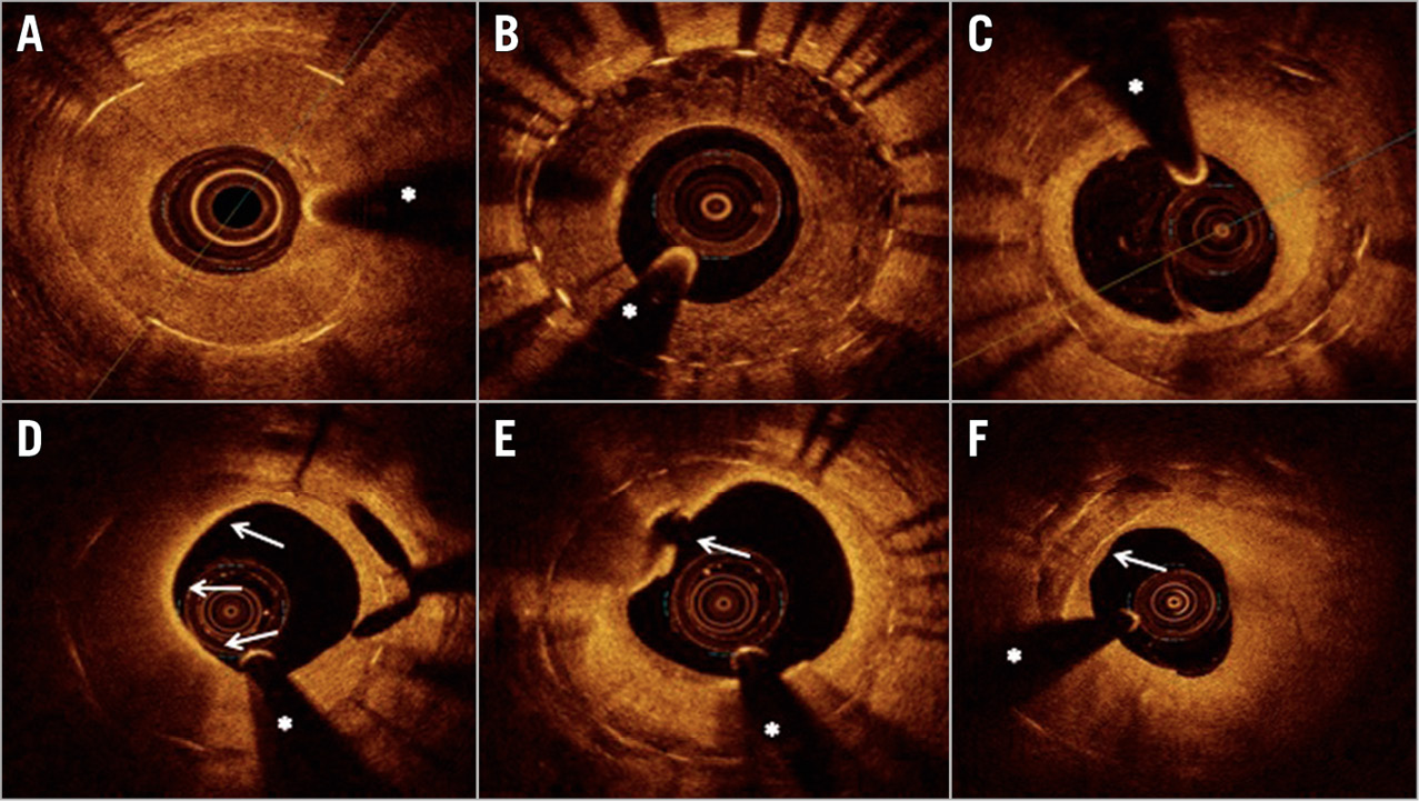 Figure 1. Representative images of optical coherence tomography findings in patients presenting with in-stent restenosis. A) Homogeneous neointimal pattern. B) Heterogeneous neointimal pattern. C) Layered neointimal pattern. D) Macrophage infiltration involving a 180° neointimal arc (arrows from 6 to 12 o’clock). E) Neoatherosclerosis and ruptured thin-cap fibroatheroma (arrow). F) Neointimal calcification (arrow). * guidewire artefact.