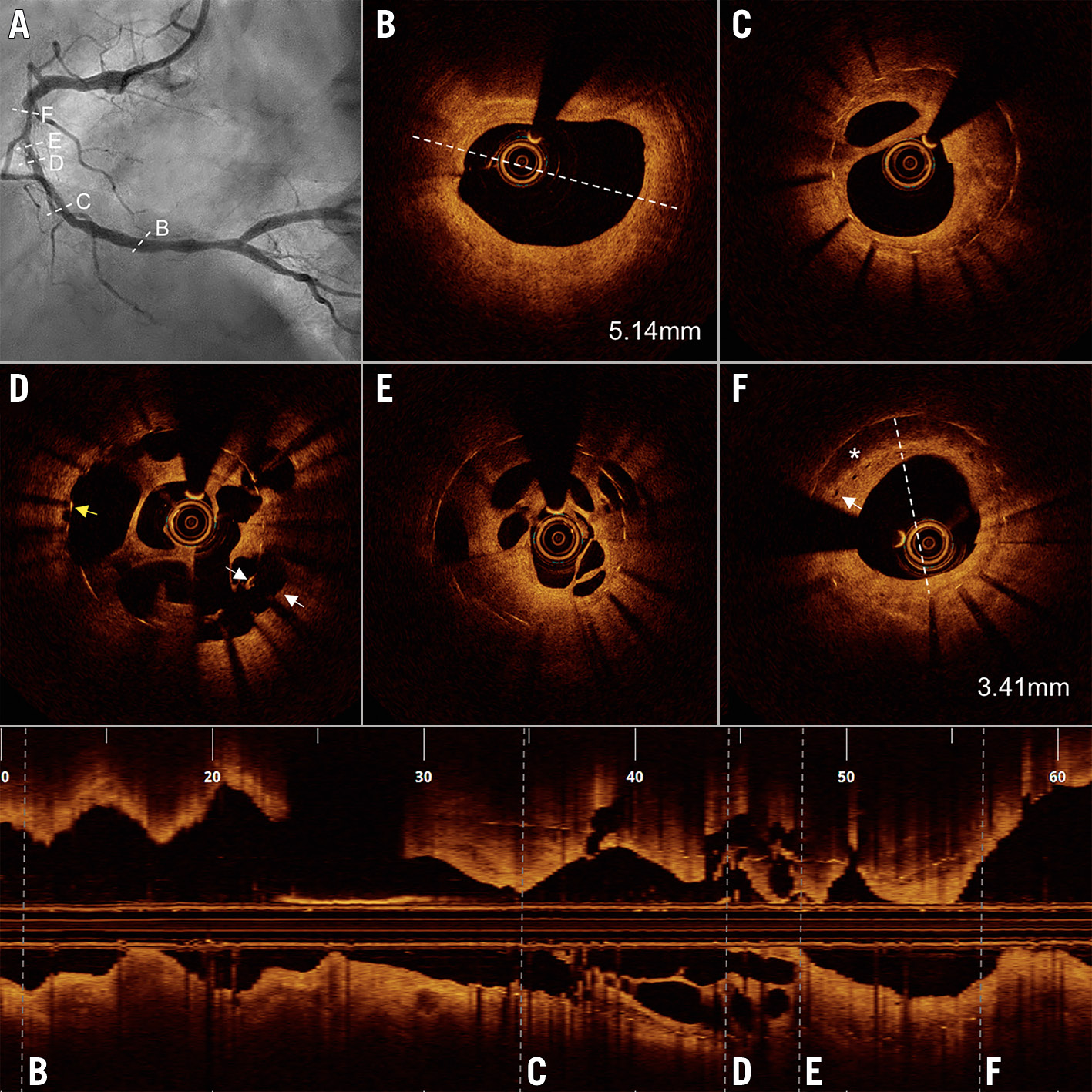 Figure 1. Angiography and optical coherence tomography findings. A) Angiography showed in-stent restenosis in the right coronary artery. B) External elastic membrane diameter at the distal reference was 5.14 mm. C) - E) Recanalised thrombus with multiple channels within the stent. D) Recanalised thrombus with malapposition (white arrows) and uncovered struts (yellow arrow). F) Neoatherosclerosis with lipid pool (asterisk) and microvessels (white arrow) in the setting of an undersized stent.