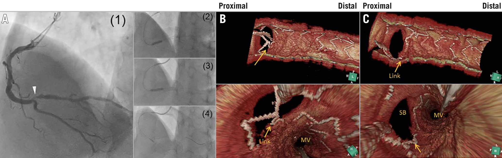 Figure 3. A representative effective case of GB dilation after crossover stenting. A) Coronary intervention. (1) Baseline coronary angiography showed a 0,1,0 bifurcation lesion with right bifurcation angle in the distal RCA. (2) A 3.25/15 mm XIENCE Xpedition® stent (Abbott Vascular) was deployed at 12 atm. (3) The stent delivery balloon was inflated at 16 atm again after some retrieval of the balloon proximally to appose the stent completely. (4) A 2.5/4 mm GB was inflated at the SB ostium. B) Three-dimensional OCT images after guidewire recrossing the SB (upper, cut-plane view; lower, fly-through view). The guidewire was recrossed in the distal cell; however, a link connection was located at the centre of the carinal site (arrows). C) Three-dimensional OCT images after the GB dilation. The jailed strut and link connection were clearly removed from the SB ostium (arrows).