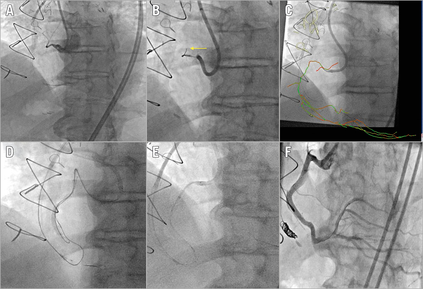 Figure 1. Computed tomography angiography (CTA)/real-time fluoroscopy fusion to clarify proximal cap ambiguity. Proximal right coronary artery (RCA) chronic total occlusion with proximal cap ambiguity due to the presence of obscuring side branches (A). The wire kept entering into the side branches (arrow) (B). Upward course of the RCA clarified with CTA/coronary fluoroscopy co-registration (C). The antegrade wire entered the subintimal space. It was then decided to proceed with reverse controlled antegrade and retrograde subintimal tracking (D). Four drug-eluting stents were implanted with the aid of a GuideLiner® guide extension (Teleflex Medical, Wayne, PA, USA) (E). Final result (F).