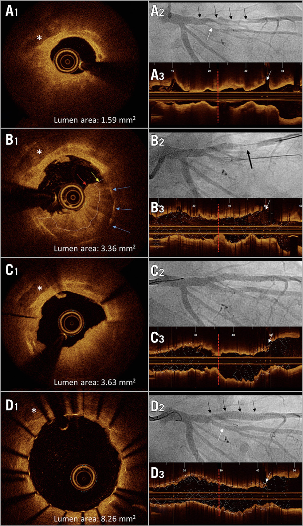 Figure 1. Stent thrombosis due to atheromatous protrusion after stenting. Left: cross-sectional OCT images (A1-D1; *=calcification) at four stages. Right: corresponding coronary angiographies (A2-D2; black arrows=LAD; white arrows=diagonal branch) and longitudinal OCT views of LAD (A3-D3; red vertical bars indicate site of stent thrombosis and correspond to site of OCT cross-sections; white arrows=diagonal branch). A1-A3. Pre-interventional OCT/angiography: circumferential, predominantly lipid-rich plaque (A1). B1-B3. OCT/angiography of stent thrombosis (arrow in B2): OCT (B1) shows thrombus (red arrow) attached to atheromatous protrusion (yellow arrow), blue arrows=buried stent struts. C1-C3. OCT/angiography two days later: residual stenosis due to protruding mass (C1). D1-D3. Final OCT/angiography: protruding material successfully compressed by additional stent, achieving good lumen area.