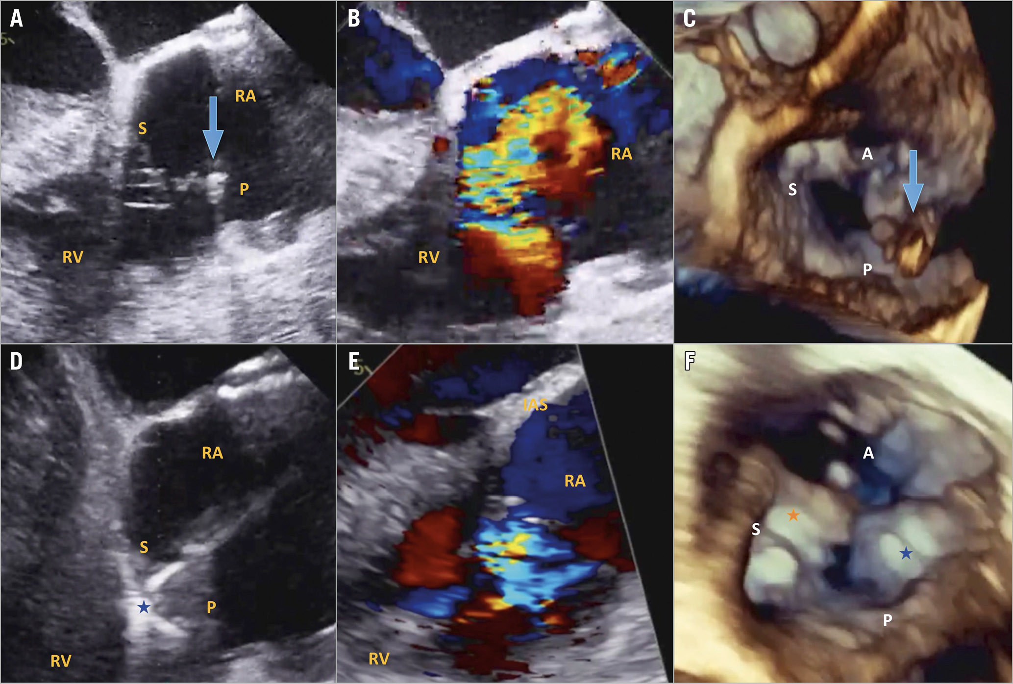 Figure 1. TTVr with the modified TriClip/MitraClip G4 system. A) Baseline transoesophageal echo (TEE) 150-degree view demonstrating large posterior leaflet flail. B) Baseline TEE 150-degree view with colour Doppler demonstrating torrential tricuspid regurgitation (TR). C) 3D TEE view demonstrating posterior leaflet flail. D) TEE 150-degree view of leaflet grasping with the MitraClip G4 XTW. E) Post-procedural TEE 150-degree view demonstrating moderate TR. F) 3D TEE view demonstrating tissue bridge and elimination of posterior flail. A: anterior leaflet; P: posterior leaflet; RA: right atrium; RV: right ventricle; S: septal leaflet. Blue arrow indicates flail posterior leaflet, orange star indicates TriClip XT between anterior and septal leaflets, blue star indicates MitraClip G4 XTW between posterior and septal leaflets.