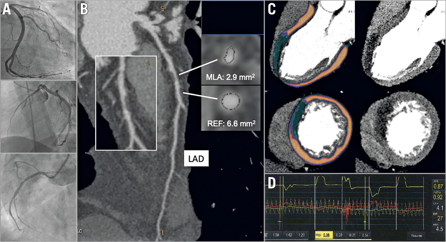 Figure 1. Myocardial ischaemia detected by stress CT perfusion. A 54-year-old man, previous PCI and DES in the mid-distal portion of a dominant left circumflex artery, symptomatic for exertional angina. ICA was negative for in-stent restenosis or de novo stenosis (A). CCTA showed an intermediate stenosis (50-55%) in the middle portion of the left anterior descending artery (LAD), with a minimal lumen area of 2.9 mm2 at cross-sectional reconstruction (B). Stress CTP long- and short-axis reconstructions (C) showed a transmural perfusion defect of the anterior interventricular septum. Invasive physiological assessment (D) demonstrated microvascular dysfunction in the territory of the LAD without functional relevance of the epicardial stenosis (IMR=27, FFR=0.87).