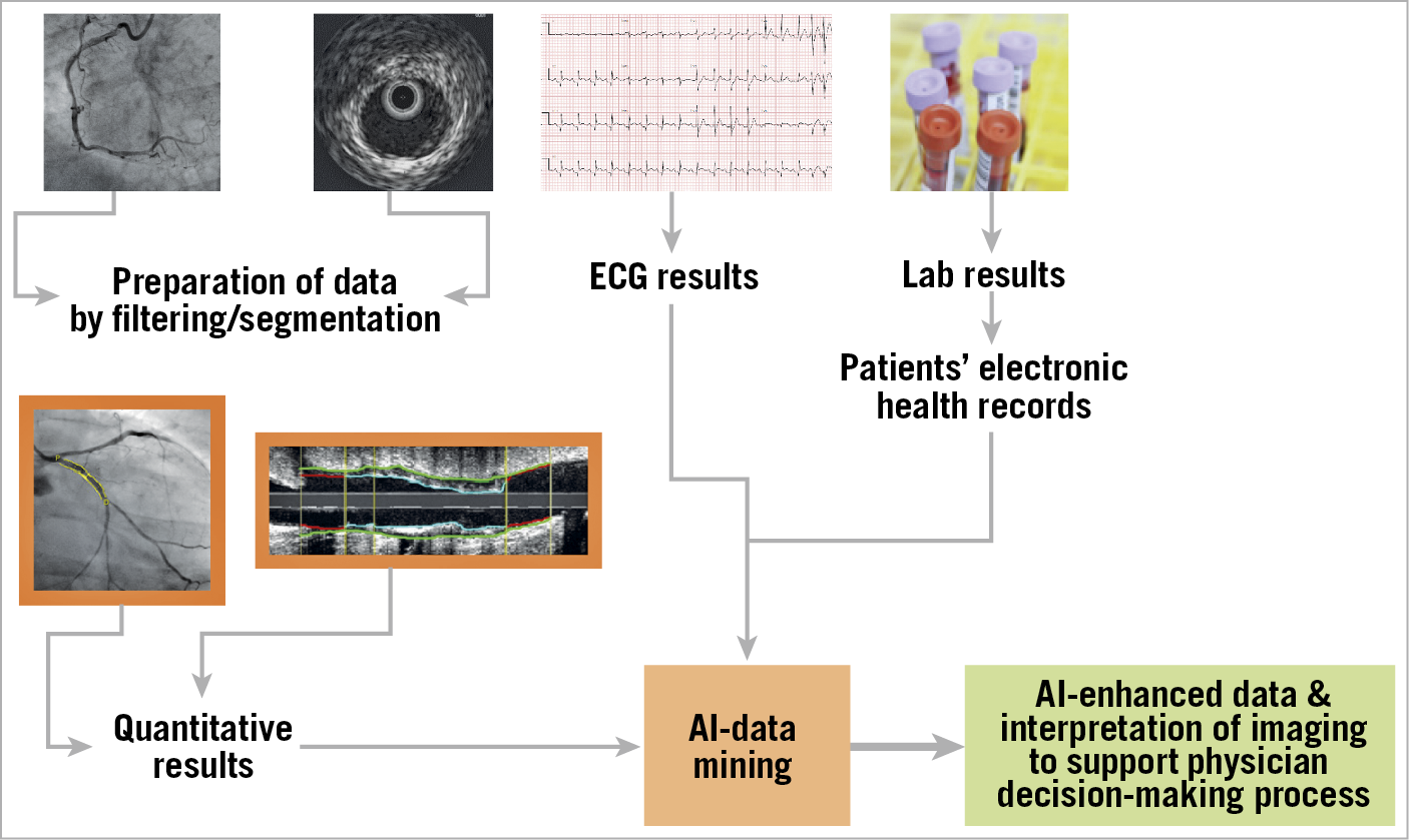 Figure 1. Schematic presentation of the use of artificial intelligence (AI) with data mining in the interventional laboratory. Integration of X-ray and intravascular imaging data, ECG, laboratory results, and the patient’s electronic health records are analysed by AI. Imaging interpretation will be supported by AI and enhanced by real-time clinical, laboratory and other important information to support the physician’s decision-making process.
