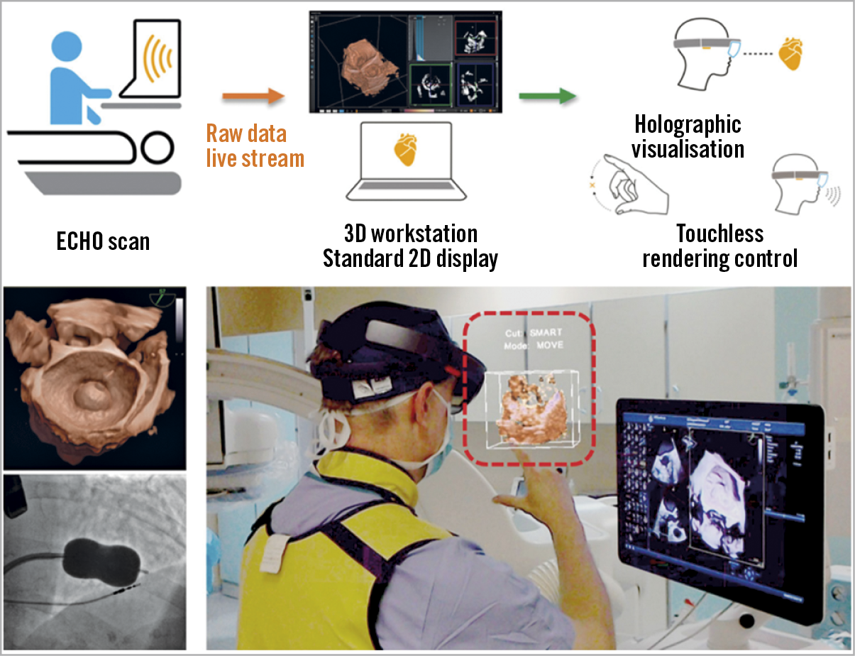 Figure 2. The HoloLens mixed reality display (Microsoft, Redmond, WA, USA) is used to overlay 3D data on a hologram reality view during a balloon mitral valve intervention. Data obtained for ultrasound echocardiography are visible as a semi-transparent holographic cube positioned in front of the echocardiographist and shared by an interventional cardiologist. Reproduced with permission from Kasprazak et al26, and from the European Society of Cardiology. All rights reserved.
