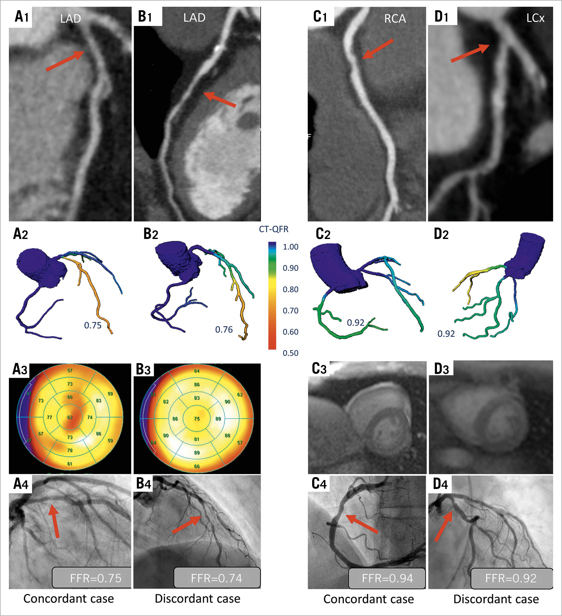 Figure 3. Illustrative examples of four study patients. A1-A4 indicate coronary CTA-identified intermediate stenosis on the LAD (A1) considered obstructive by CT-QFR (A2), MPS (A3) and invasive FFR (A4). B1-B4 indicate calcified and soft plaques on coronary CTA (B1) considered obstructive by CT-QFR (B2) and invasive FFR (B4) but not by MPS (B3). C1-C4 indicate coronary CTA-identified intermediate stenosis on the RCA (C1) not considered obstructive by CT-QFR (C2), CMR (C3) and invasive FFR (C4). D1-D4 indicate plaques on coronary CTA (D1) not considered obstructive by CT-QFR (D2) and invasive FFR (D4) but obstructive by CMR (D3). CT-QFR: CT-derived quantitative flow ratio; FFR: fractional flow reserve; ICA: invasive coronary angiography; LAD: left anterior descending artery; LCx: left circumflex artery; RCA: right coronary artery