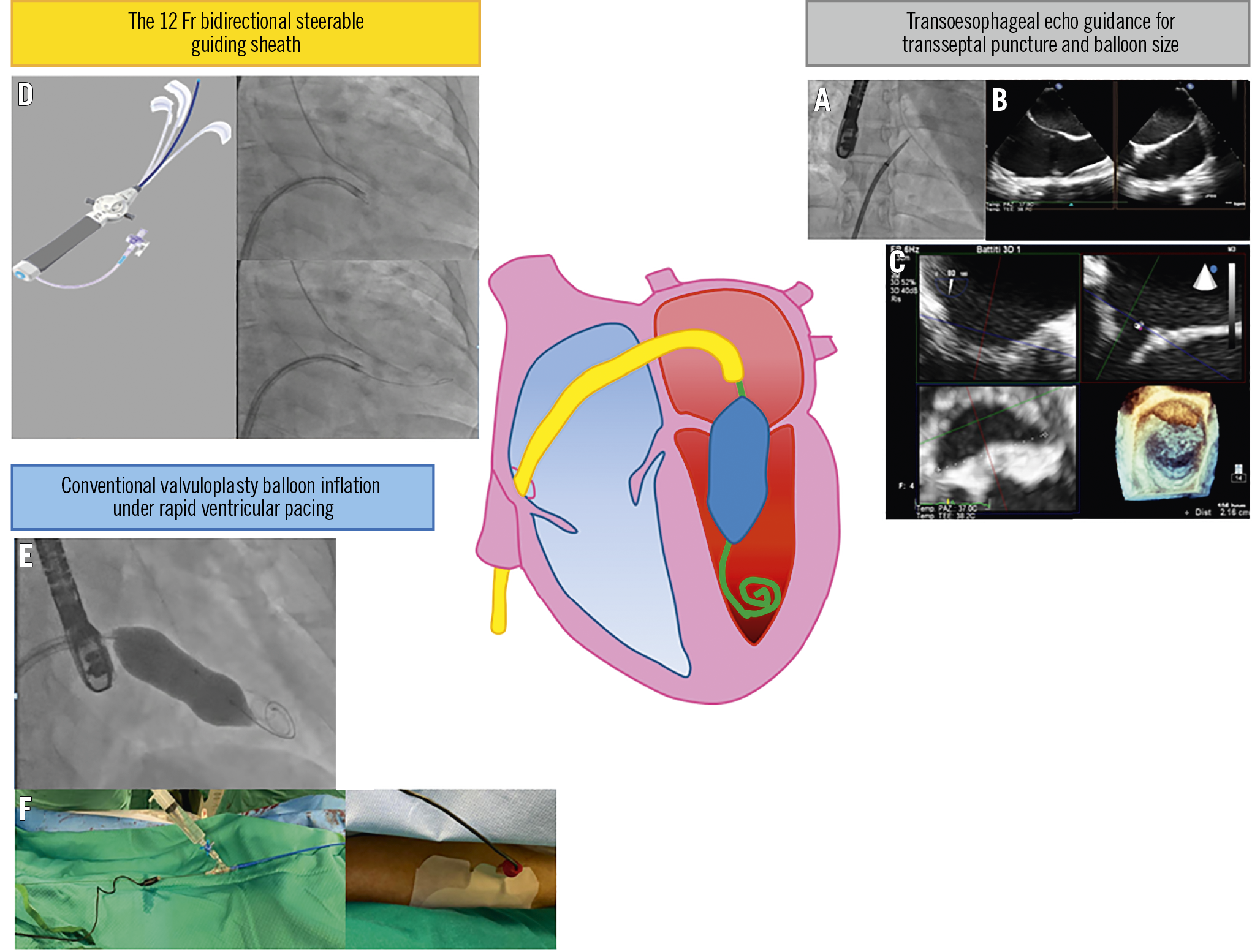 Figure 1. Strengths of the novel technique for percutaneous mitral valvuloplasty.