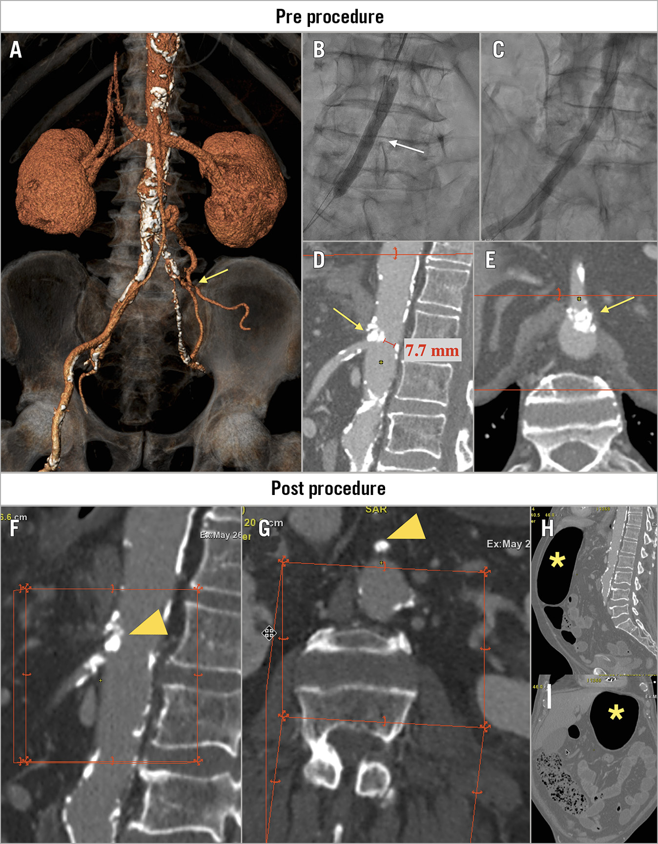 Figure 1. Pre- and post-procedure imaging. A) 3D-CT showing severe and extensive calcification of the descending aorta, iliac and femoral arteries along with a chronic common left iliac artery occlusion (yellow arrow). B) Intravascular lithotripsy (IVL) of the right iliac artery (white arrow). C) Iliac angiography post IVL. D) & E) Pre-procedure CT showing a calcified nodule at the origin of the superior mesenteric artery (SMA) without flow compromise (yellow arrows). F) & G) Occlusion of the SMA due to an eruptive calcified nodule protruding into the lumen (yellow arrowheads). H) & I) Abdominal CT showing a large gastric bubble and distended transverse colon loops (yellow asterisks).