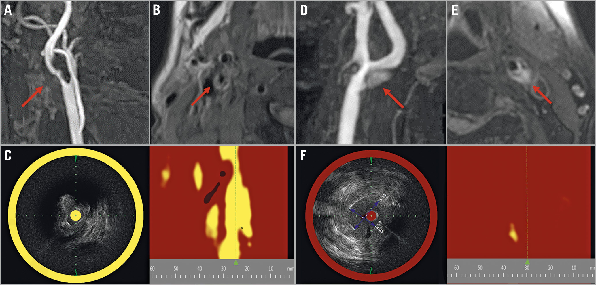 Figure 1. Findings from NIRS-IVUS and MRI of carotid plaques. A) Right symptomatic carotid stenosis in a 79-year-old man on TOF image (arrow). B) Plaque has slightly higher intensity on the T1-weighted image (arrow). C) NIRS-IVUS has a very high LCBI (961) at the MLA segment. This patient presented with embolic stroke and stent occlusion after CAS. D) Left asymptomatic carotid stenosis in a 72-year-old man on TOF image (arrow). E) Plaque manifests as higher intensity than adjacent muscle on the T1-weighted image (arrow). F) NIRS-IVUS reveals very low LCBI (111) at the MLA segment. Embolic events did not occur after CAS in this patient. CAS: carotid artery stenting; IVUS: intravascular ultrasound; LCBI: lipid core burden index; MLA: minimal lumen area; MRA: magnetic resonance angiography; MRI: magnetic resonance imaging; NIRS: near-infrared spectroscopy; TOF: time-of-flight