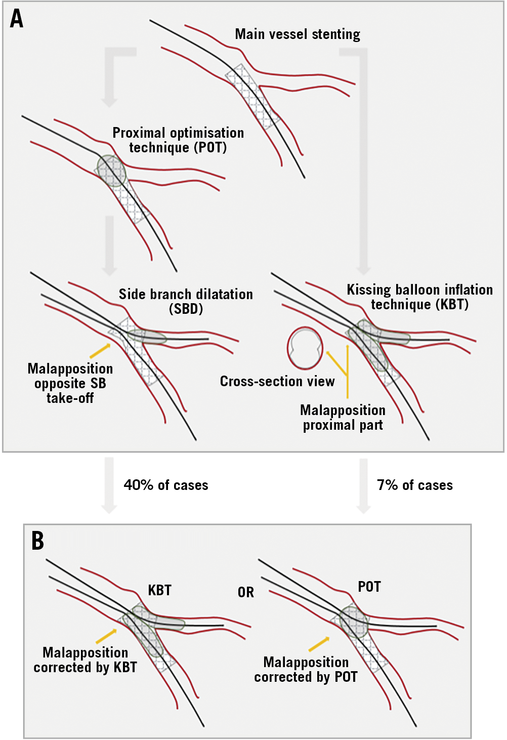 Figure 1. Theoretical procedure versus actual procedure. A) Sketch of the research question. Proximal optimisation technique (POT) followed by side branch dilatation results in malapposition opposite the side branch take-off (left). Kissing balloon inflation technique (KBT) results in malapposition of the proximal part. B) Actual study procedure (right). KBT corrects malapposition opposite the SB. POT corrects malapposition in the proximal part.