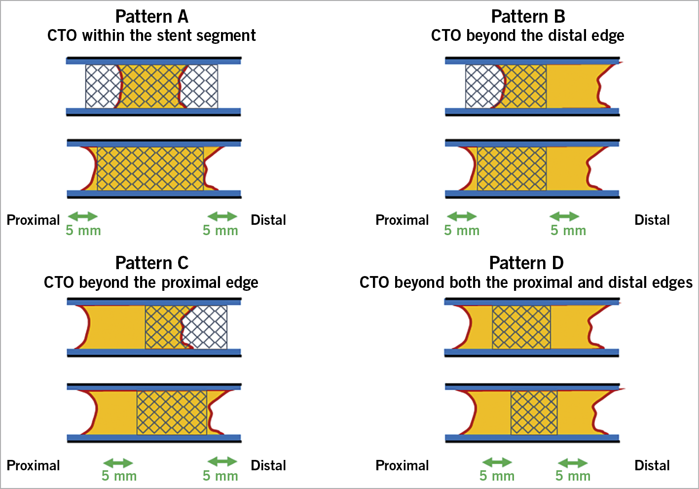 Central illustration. Occlusion patterns of in-stent chronic total occlusions. According to the occlusion patterns, in-stent CTOs were divided into the following groups. A) CTO within the stent segment. B) CTO beyond the distal edge. C) CTO beyond the proximal edge. D) CTO beyond both the proximal and distal edges. An edge was defined as an area 5 mm from the stent edge. The stent segment included the in-stent region as well as the proximal and distal edges.  An edge was defined as an area 5 mm from the stent edge. The stent segment included the in-stent region, as well as the proximal and distal edges. The selection of the CTO-PCI strategy was at the operator’s discretion. In each occlusion pattern, the procedural strategies were classified into an antegrade approach alone, rescue bidirectional approach, and primary bidirectional approach. The procedural strategy, guidewire success, technical success, procedural success, procedural time, contrast volume, fluoroscopic time, in-hospital major adverse cardiac and cerebrovascular events (MACCE), and other complications were compared among the four occlusion patterns. The guidewire crossing time was also compared to the guidewire success.