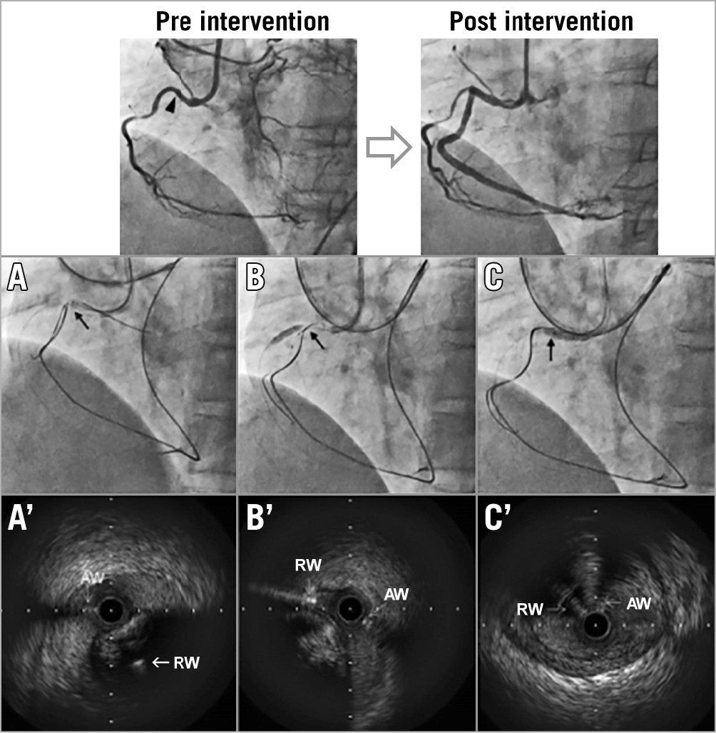 Figure 1. Chronic total occlusion treated with intravascular ultrasound-guided retrograde approach. The top panels show pre-intervention and final angiography. Black arrowhead indicates the proximal cap of the CTO. Lower panels show angiography (A-C) and corresponding IVUS (A′-C′) at each step. Black arrow indicates IVUS location. When the AW and RW overlapped longitudinally (A), IVUS (A′) showed a subintimal AW and an intraplaque RW. After repositioning the RW (B), IVUS (B′) showed that both the AW and the RW were subintimal. Subsequently, the RW crossed into the true lumen proximal to the CTO (C, C′). AW: antegrade wire; CTO: chronic total occlusion; IVUS: intravascular ultrasound; RW: retrograde wire