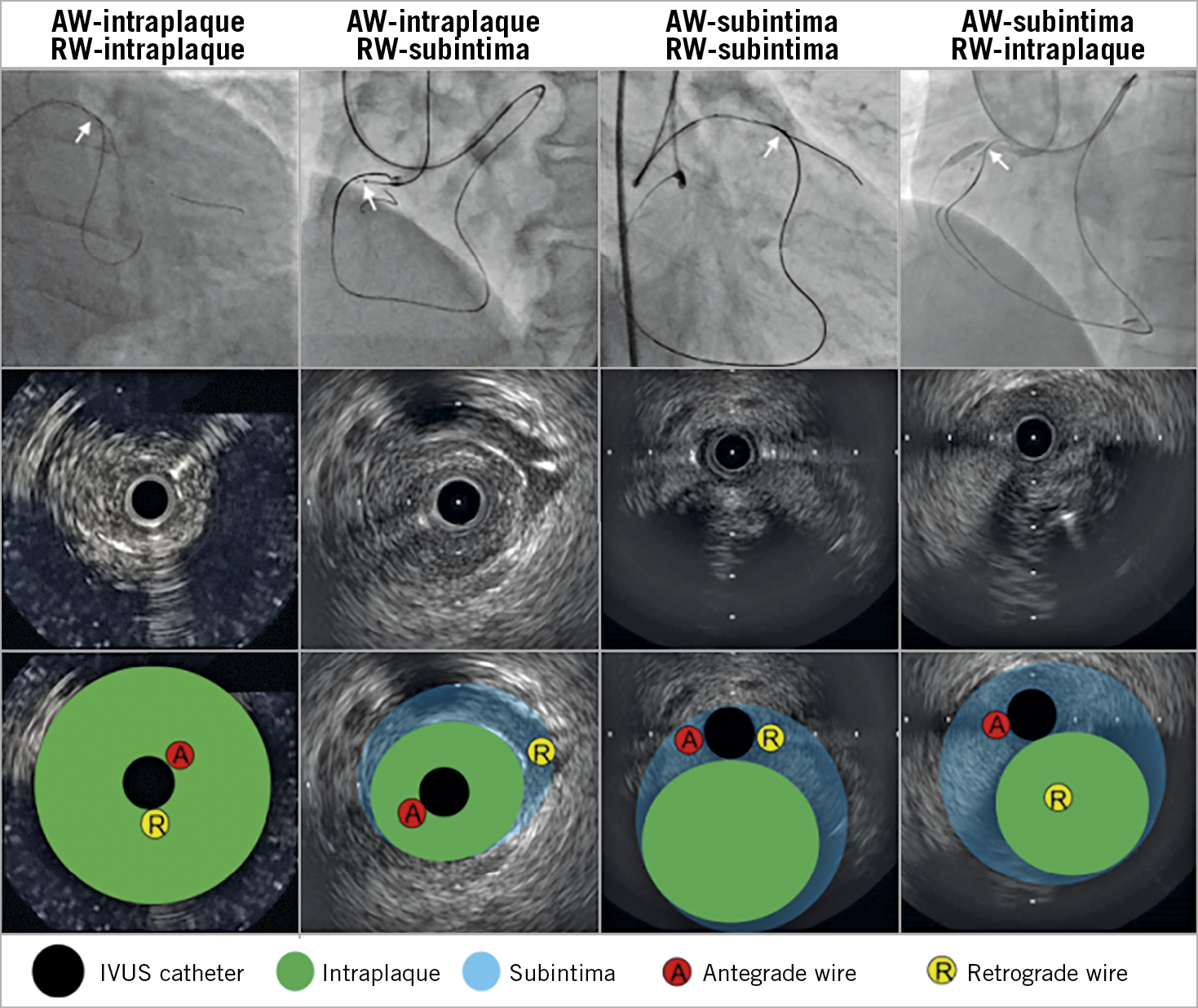 Figure 2. Four patterns of antegrade and retrograde wire positions. In the top panels, angiography shows overlapped AW and RW. White arrows indicate IVUS location. Middle panels show corresponding IVUS images; bottom panels show the same IVUS images with annotation. AW: antegrade wire; IVUS: intravascular ultrasound; RW: retrograde wire