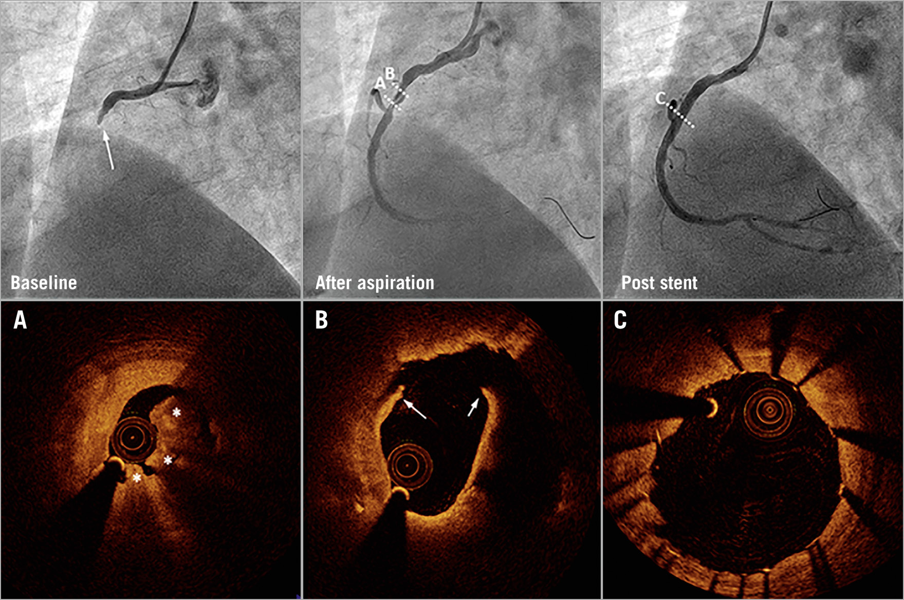 Figure 3. Coronary angiography and optical coherence tomography in a control patient. Baseline angiography (upper left) shows a patient with complete occlusion and TIMI 0 flow. After thrombus aspiration, the coronary arterial flow was restored to TIMI 3 flow. Optical coherence tomography (OCT) shows plaque rupture (white arrows) and red thrombus (white stars) (A & B). Angiography and OCT show imaging of the region after stent implantation (C).