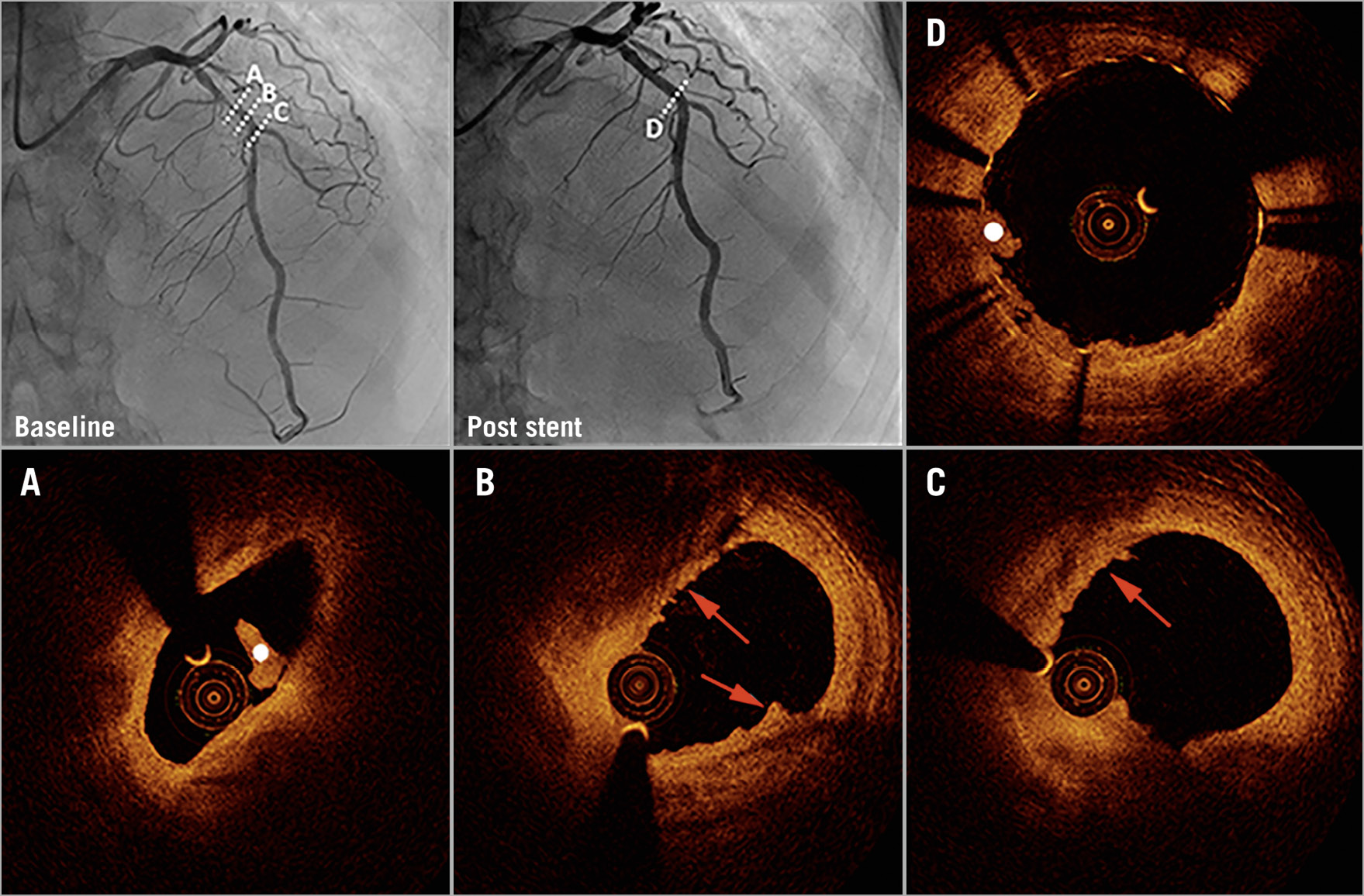 Figure 2. Coronary angiography and optical coherence tomography in early spontaneous reperfusion. Baseline angiography (upper left) shows a patient with TIMI 3 flow. Optical coherence tomography (OCT) shows plaque erosion (red arrows) and white thrombus (white dot) (A-C). Coronary angiography (upper middle) and OCT show imaging of the region after stent implantation (D).