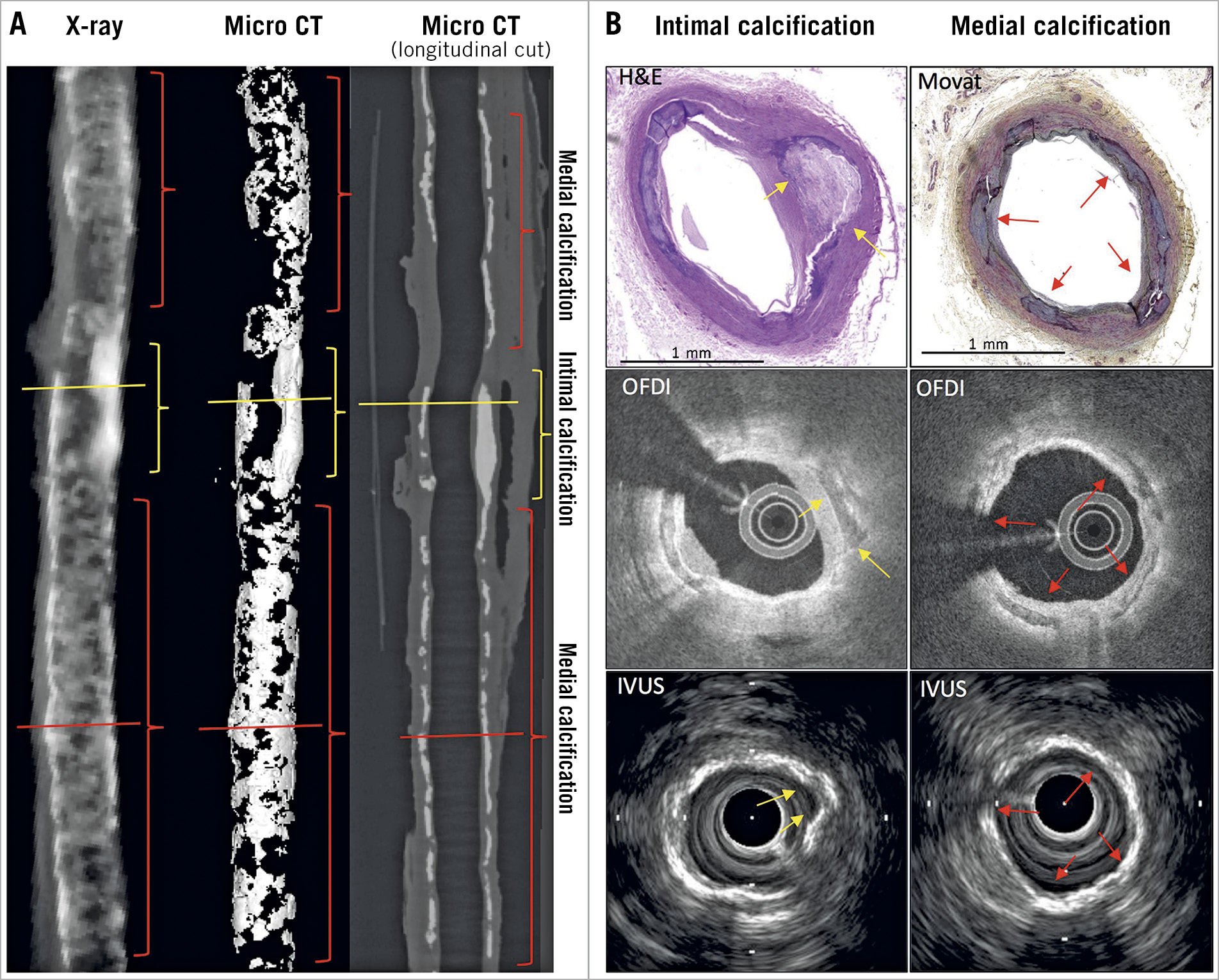 Central illustration. Differences in the longitudinal appearance of intimal versus medial calcification. A) Longitudinal images with X-ray on the left, micro CT highlighting calcification in the middle, and sagittal view of micro CT image in the right panel. Intimal calcification shows longitudinally thick calcification (yellow lines and brackets), whereas medial calcification shows a thin layer of calcification (red lines and brackets). B) Histologic images (H&E [left] and Movat’s pentachrome [right] stains), with corresponding OFDI and IVUS images showing intimal calcification (yellow arrows) corresponding to yellow lines in panel A. The panels on the extreme right show images corresponding to red lines from panel A, indicating medial calcification (red arrows), shown by histology, OFDI and IVUS. CT: computed tomography; IVUS: intravascular ultrasound; OFDI: optical frequency domain imaging