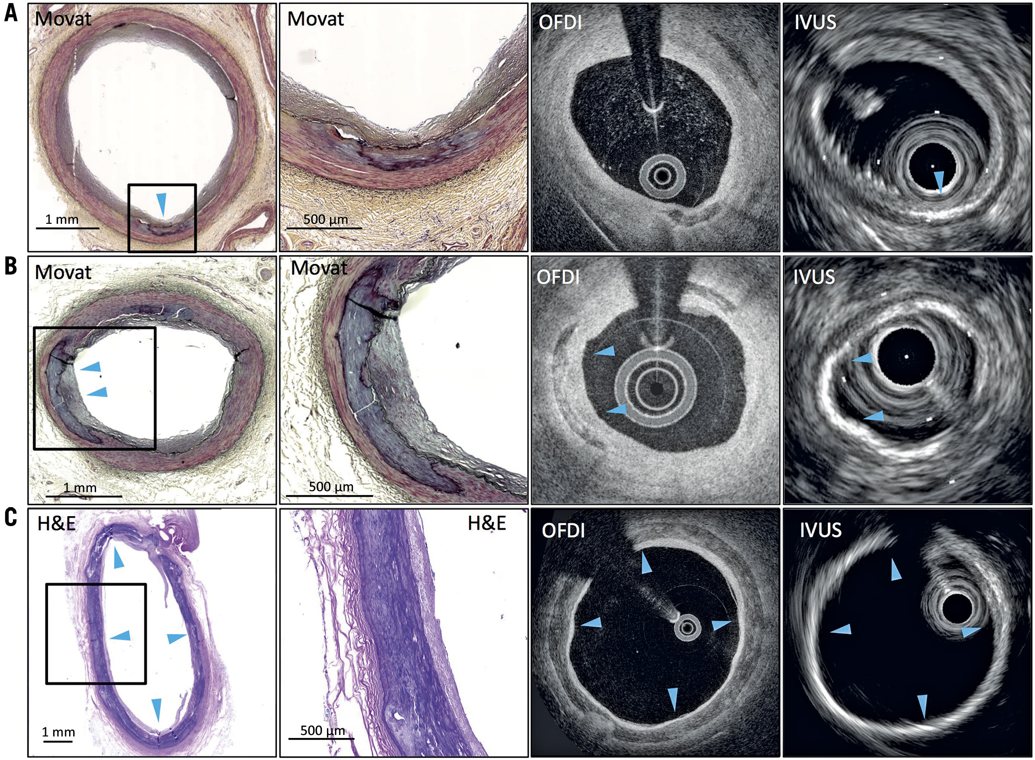Figure 1. Representative images of medial calcification by IVUS and OFDI co-registered with histology. A) Medial punctate calcification. OFDI shows calcification with clear border (blue arrow). IVUS shows high echoic signal with a low acoustic shadow near the IEL. B) Histological section shows fragmented medial calcification. OFDI shows calcification in media, whereas IVUS shows a high echoic signal right under the IEL due to blooming artefact. C) Circumferential medial sheet calcification. OFDI shows circumferential calcification and IVUS shows high echoic signal with a strong acoustic shadow. Medial calcification (blue arrowheads). IEL: internal elastic lamina; IVUS: intravascular ultrasound; OFDI: optical frequency domain imaging