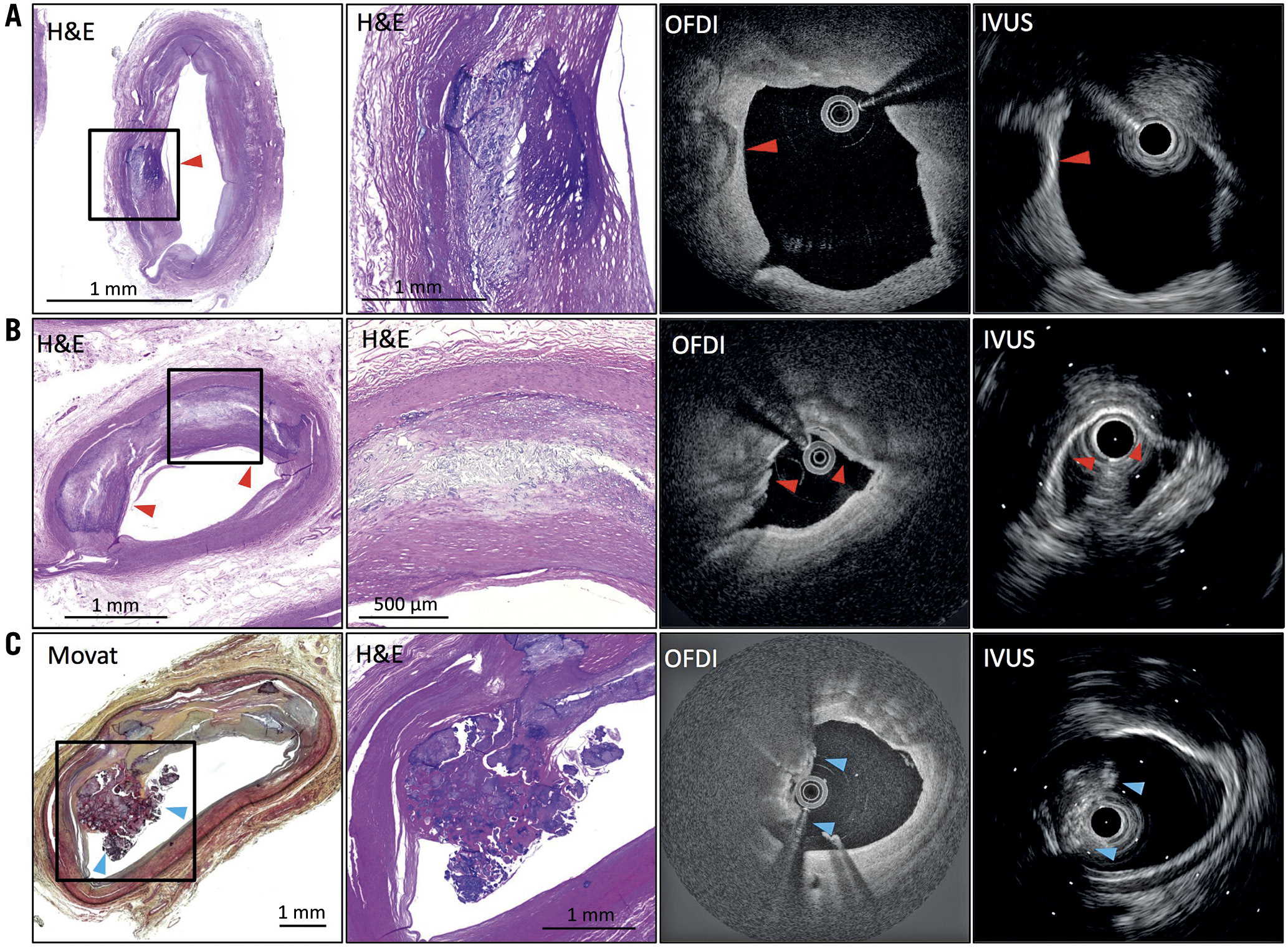 Figure 2. Representative images of intimal calcification by IVUS and OFDI co-registered with histology. A) Intimal fragmented calcification (red arrow). OFDI shows calcification with clear border only on the luminal side. IVUS shows high echoic signal with a strong acoustic shadow. B) A histological section shows superficial intimal calcification (red arrows). OFDI shows a clear border between intima and calcification; however, the abluminal edge of calcification is not visible due to its deep location. IVUS shows high echoic signal with a strong acoustic shadow derived from the presence of calcification. C) Intimal calcified nodule (blue arrows). There is no endothelium and collagen on the surface of the nodules. OFDI shows irregular protruded mass with attenuation signal in contact with large calcification. IVUS shows protruded and irregular mass with high acoustic shadow. IVUS: intravascular ultrasound; OFDI: optical frequency domain imaging