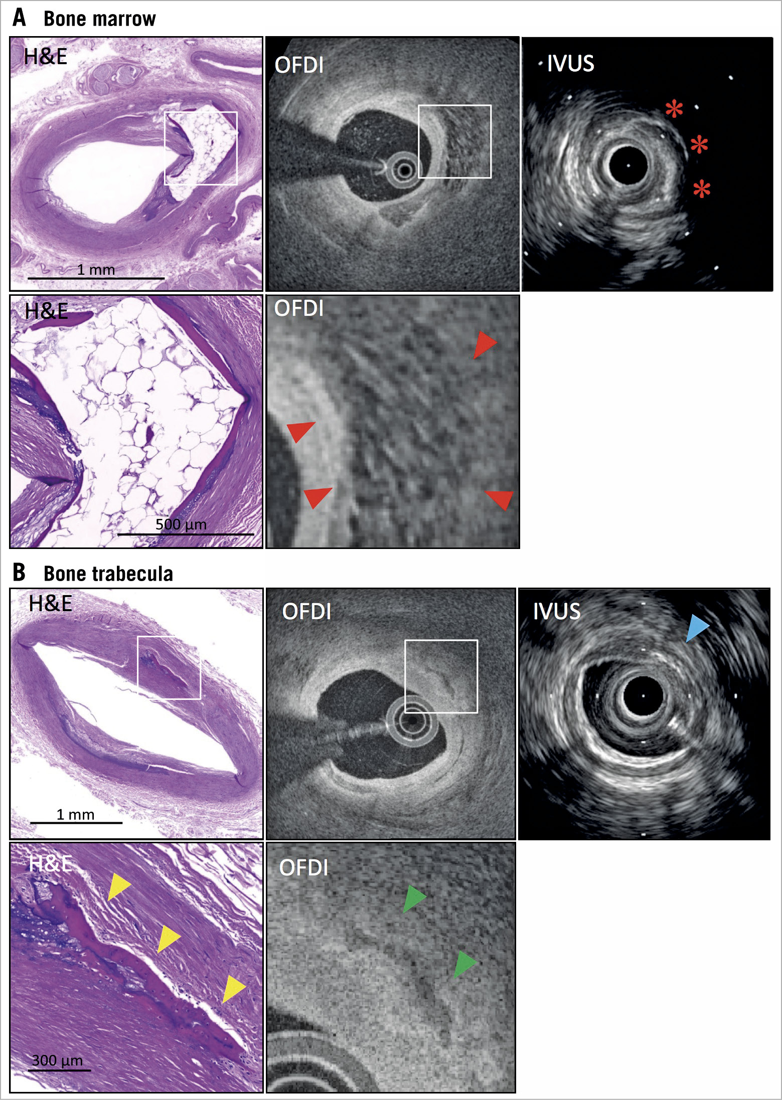 Figure 3. Findings of bone formation by IVUS and OFDI co-registered with histology. A) Histological image shows bone formation in the intima. High-power image shows thin trabecular bone at the edges of the bone marrow. OFDI shows honeycomb sign, indicating bone marrow best appreciated on high-power images (red arrowheads). IVUS shows high echoic signal with strong acoustic shadow (red asterisks). Lower panels show high-power images from white boxes in upper histological and OFDI panels. B) Histological image shows trabecular bone (yellow arrowheads) without bone marrow. OFDI shows irregular calcification (green arrowheads). IVUS shows high echoic sign (blue arrow) in intima-media border. Lower panels show high-power images from white boxes in upper histological and OFDI panels. IVUS: intravascular ultrasound; OFDI: optical frequency domain imaging