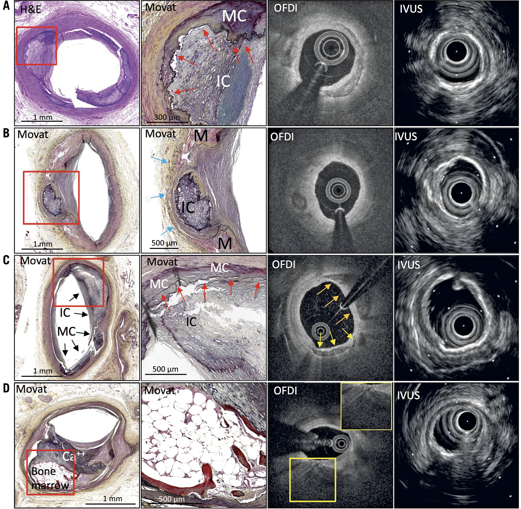 Figure 5. Misreading cases of medial calcification and bone formation. The left panels in histology show low-power images and the adjacent panels show high-power images from the red boxes. A) Fusion calcification. Intimal (IC) and medial calcification (MC) are connected over internal elastic lamina (red arrows). OFDI shows calcification in intima and IVUS shows high echoic signal with acoustic shadow within the intima. B) Medial thinning from intimal calcification. Intimal calcification invades the medial wall where the media (M) becomes thin and is almost absent (blue arrows). OFDI shows calcification located deep in the intima, and IVUS shows high echoic signal near the intima-media border. C) Intimal and medial calcifications are located side by side. The high-power images show that the IC and MC are connected over internal elastic lamina (red arrows). OFDI shows likely intimal calcification (orange arrows) and medial calcification (yellow arrows). IVUS shows likely medial calcification. D) Histological image shows bone formation with overlying thick calcification (Ca++). OFDI shows thick calcification. It is difficult to observe the deeper area due to attenuation from thick calcification. IVUS shows high echoic signal at the luminal surface. IVUS: intravascular ultrasound; OFDI: optical frequency domain imaging